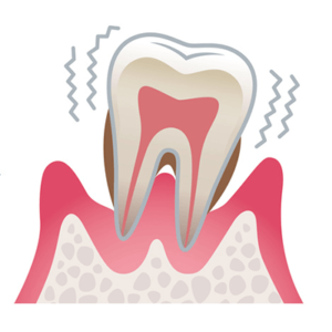 歯周病の進行（重度）